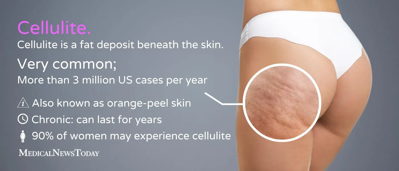 infographic cellulite medical facts